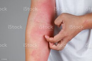 Skin Disorder