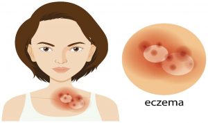 What is Eczema in Ayurveda